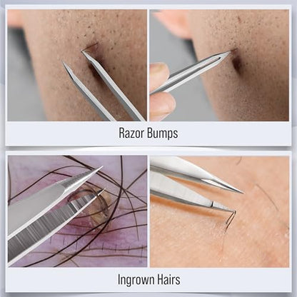 DUROX 3-Piece Tweezers Set for Ingrown Hair & Splinter Removal - 1. Pointed Ingrown Hair Tweezers, 2. Sharp Splinter & Sliver Remover, 3. Blunt Tip Facial & Chin Hair Tweezers, Stainless Steel, Pouch
